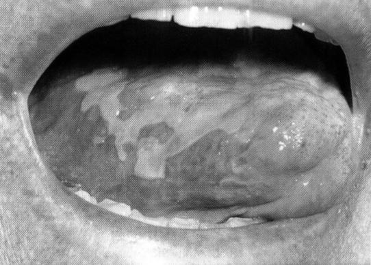 Xerostomia Boca seca ou secura da boca: é um sintoma relacionado à falta de saliva.