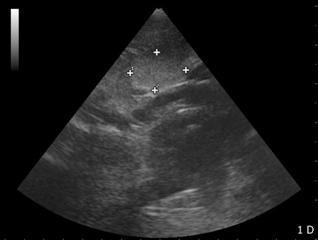 B) Válvulas atrioventriculares abertas (seta). C) O átrio evidencia projeções da superfície interna. Sua espessura parece aumentada por estar em sístole.