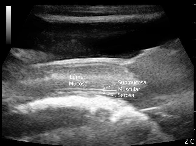 C) Aproximação e definição da estratificação parietal. D) Intestino grosso com conteúdo gasoso e parede hipoecóica delgada. Est, Estômago; Bx, Bexiga; ID, Intestino delgado; IG, Intestino grosso.