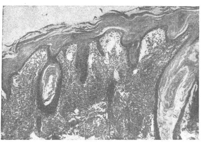 HANSENÍASE TUBERCULÓIDE REACIONAL 49 Fig. 2 Vista panorâmica, vendo-se: hiperparacetorase com tampões córneos; atrofia da camada de Malpighi e alargamento das papilas. H.E. x 38. Fig. 3 Reação granulomatosa do derma, com alargamento das papilas.