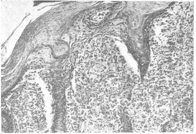 Esses granulomas epitelióides têm limites mal definidos e entre êles existe infiltrado linfocitário (Fig.