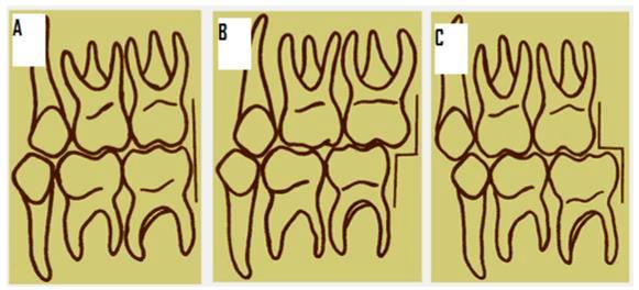 19 Figura 1- Relação terminal dos segundos molares decíduos. A: em plano reto; B: em degrau mesial; C: em degrau distal. Fonte: Yamazaki (2011 apud LEONEL, 2012, p. 24).