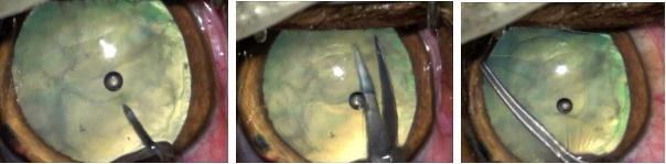 24 É preconizada a capsulotomia contínua, capsulorrexis circular contínua (Figura 9), que é a ruptura da cápsula anterior do cristalino, que expõe a córtex, onde a ponteira do aparelho fragmentará a