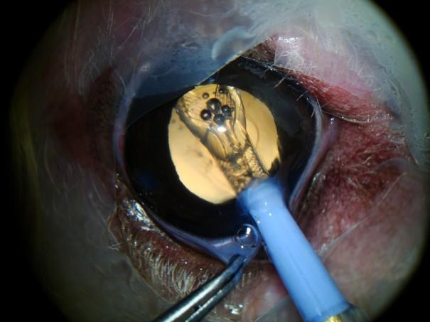 A sutura deve ser feita com fio Dexon 8-0, com ou sem hidroclusão, que consiste em provocar edema das bordas da incisão o que facilitará seu fechamento.