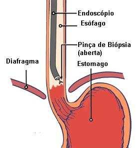 É necessário que o tipo de aço utilizado na fabricação destes componentes que formam a pinça seja um material