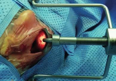 Outras vantagens: Cirurgia com incisões pequenas Risco reduzido de complicações como infecções, deiscência de feridas cirúrgicas, formação de seroma Vantagens cosméticas pós-operativas: cicatrizes