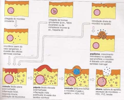 Patogênese das lesões mucocutâneas A doença microbiana da pele pode resultar de qualquer uma das três linhas de ataque: Chegada a partir da circulação