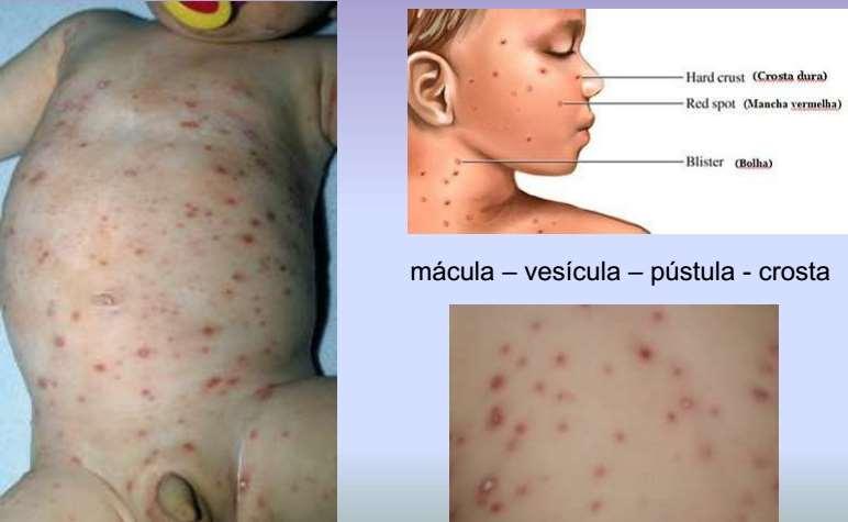 Varicela Pródromo: febre leve, mal estar Lesões surgem em grupos (tronco, depois face e couro cabeludo) Todos