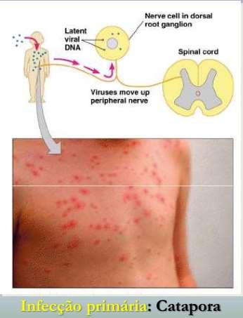 VZV: infecção primária e recorrência Herpes zoster: distribuição das