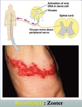 (dermátomo do sítio da reativação) Normalmente unilateral (reativação em