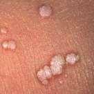 Lesões mucocutâneas causadas por vírus Que permanecem restritos a superfície corporal no sítio inicial da infecção: Tipo