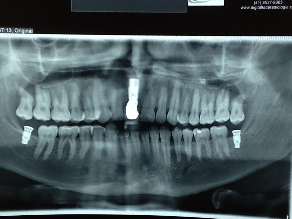 terceiros molares inferiores.