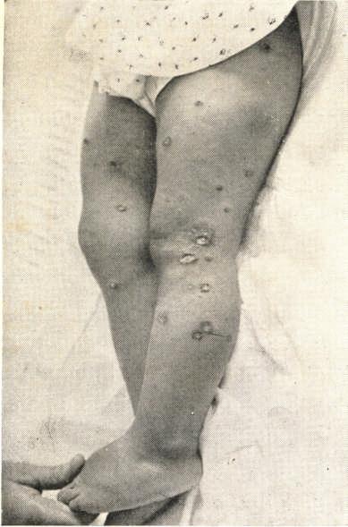 I. T. Idade 15 mêses. 13 Ficha Dermatologica inicial em 18 de Agosto de 1937. Face e Pescoço. Máculas cicatriciais hipercromiadas circundadas por bordos papuloides de coloração avermelhada.