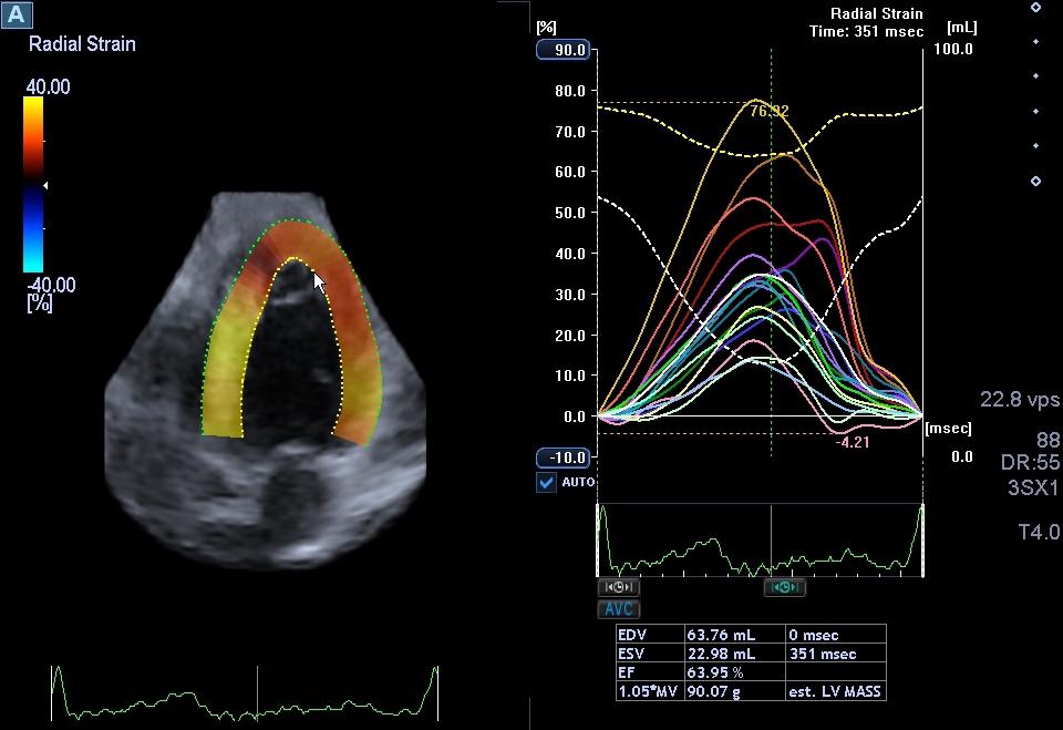 Figura 1 Ecocardiograma tridimensional mostrando a medida do strain global radial em atleta competitivo.