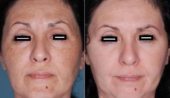 8 Fonte: Amorim 21 Figura 1 Paciente antes/depois do tratamento facial à base de peeling químico Ácido glicólico (ácido hidroxietanóico, ácido hidroxiacético) é o alfahidroxiácidos (AHA) mais curto,