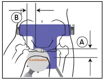 Página 9 Figura 6 5. Envolva os pés do paciente ou utilize as almofadas de inserção das botas. 6. Coloque e fixe firmemente os pés do paciente na haste do distrator e nas botas do suporte da perna saudável.