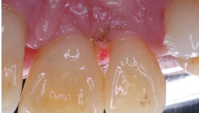 mesiolingual e disto-vestibular para disto-lingual nos dentes circunvizinhos ao defeito. Outra incisão foi feita na base da papila palatina.