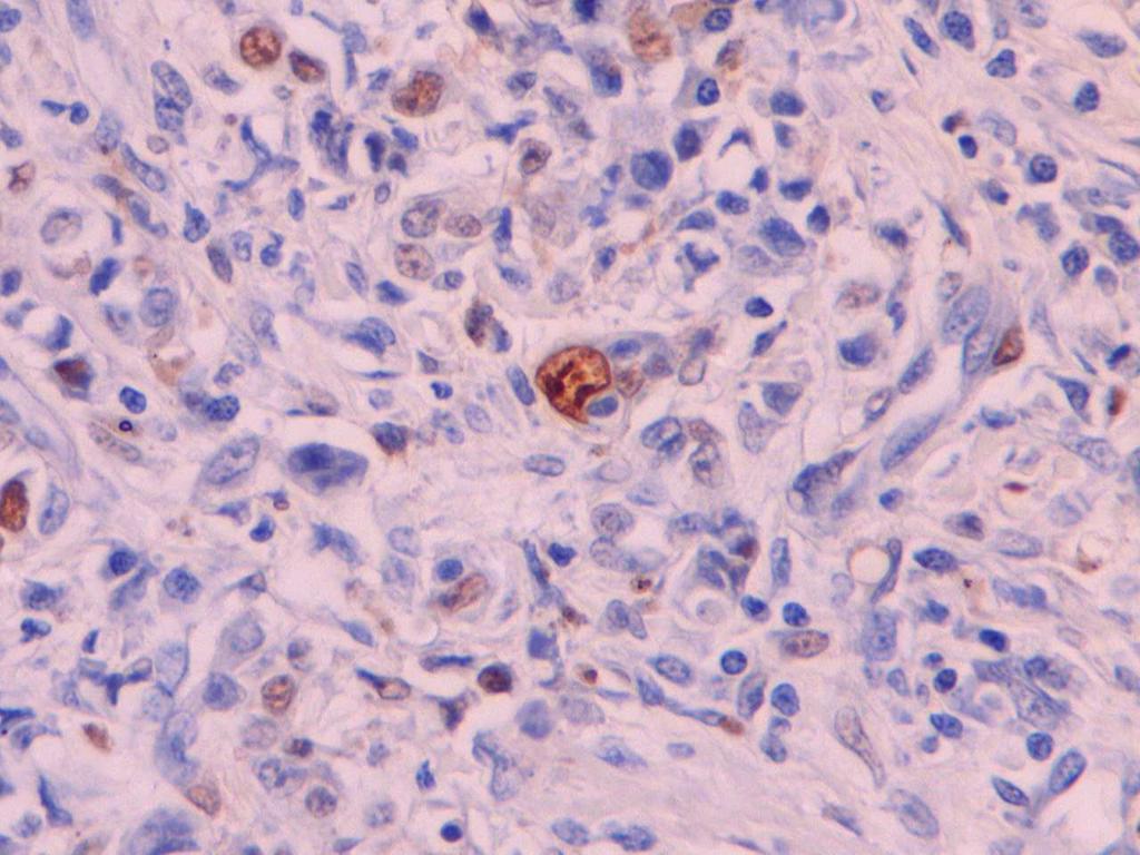 Adenocarcinoma Papilífero Simples.