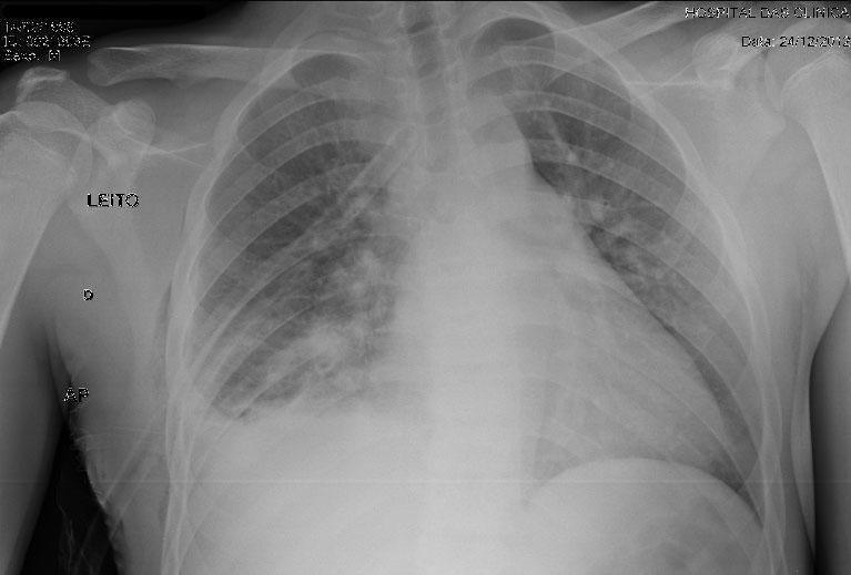 Iniciado Cetroprofeno 100mg 8/8h Evolução 25/12/12 Pela cirurgia: Débito do dreno= 50ml seroso, Oscilante, sem escape.