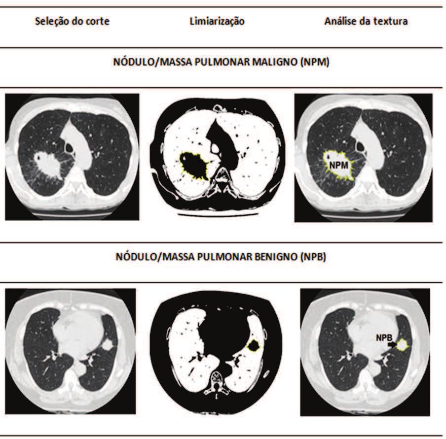 141 central ou em camadas, limites precisos (liso, circunscrito) em de decúbito, tempo de duplicação de uma lesão menor que sete computadorizada (TC) de tórax com alta resolução permitem ainda uma