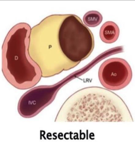 NEOADJUVANTE Tumor Ressecável Radioterapia Isolada?