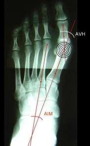 deve estar equidistante da superfície distal e lateral da epífise; os segmentos de reta são traçados e o ângulo é obtido na intersecção das duas retas, como na figura 14. É expresso em graus ( ).