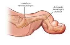 Figura 17 - Dedo em martelo (17) As articulações metatarsofalângicas anatomicamente realizam 90 graus de dorsiflexão e 30 graus de flexão plantar.