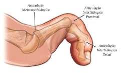 Figura 18 - Dedo em garra (17) Estas três deformidades descritas são semelhantes, mas importa saber distingui-las e conhecer as particularidades de cada uma delas, na medida em que a prevalência e