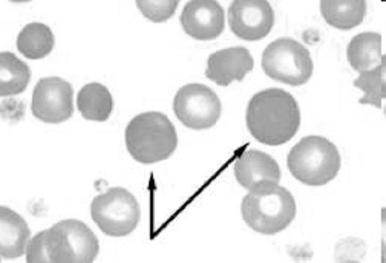 Resultado: 2,5% Lâmina de hemograma Coloração May-Gruenwald Giemsa Policromasia