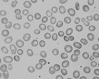 hipocromia Hemograma Índices hematimétricos CHCM CONCENTRAÇÃO DE HEMOGLOBINA CORPUSCULAR MÉDIO CHCM (%) = Hb x 100 Ht Índice Cálculo Hemograma Índices hematimétricos VGM Volume Globular Médio -