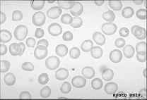 COMPLEMETARES: FERRITINA, EHB, B12... Análise da Morfologia - Microscopia Tamanho: Macrocitose ou Microcitose Forma: Anisocitose, poiquilocitose, elipticas, foice.