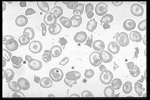 Anemias hemolíticas Carências após tratamento Esferócitos Hemáceas