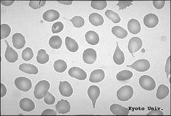 Abetaliproteinemia Doença Hepática Dacriócitos He em forma de lagrima