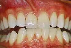 O clareamento em consultório apresenta a vantagem do resultado imediato e de gerar sensibilidade dentária por um período pequeno de tempo, geralmente de 24 horas após o tratamento.