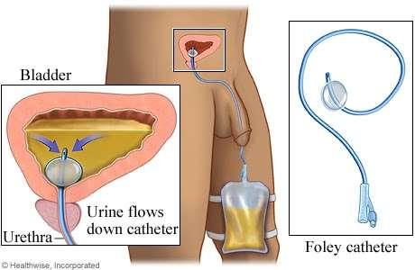 8. Procedimentos de Enfermagem no Sistema Urinário Cateterismo ou Sondagem Vesical Definição: Consiste na introdução de uma sonda estéril na bexiga, através da uretra, a fim de drenar a urina.