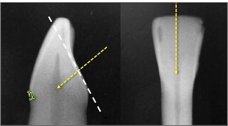 Figura 11 - Longo eixo no sentido mesiodistal e vestibulolingual nos