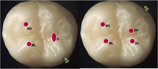 Projeção coronária das entradas dos canais. Dente com 3 canais [esquerda] e com 4 canais [direita] Figura 27 - Segundo molar inferior. Projeção coronária das entradas dos canais.