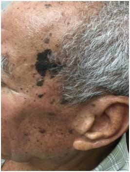 aumento. Apesar de melanomas sincônicos serem raros, a detecção desses melanomas também está em crescimento com auxílio da dermatoscopia. ra 1).