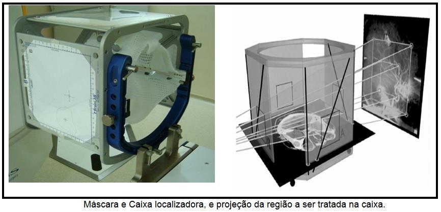 AQUISIÇÃO DE IMAGENS (RMN e CT) - LOCALIZAÇÃO ESTEREOTÁXICA A caixa possui fiduciais, ou marcadores radiopacos, identificáveis