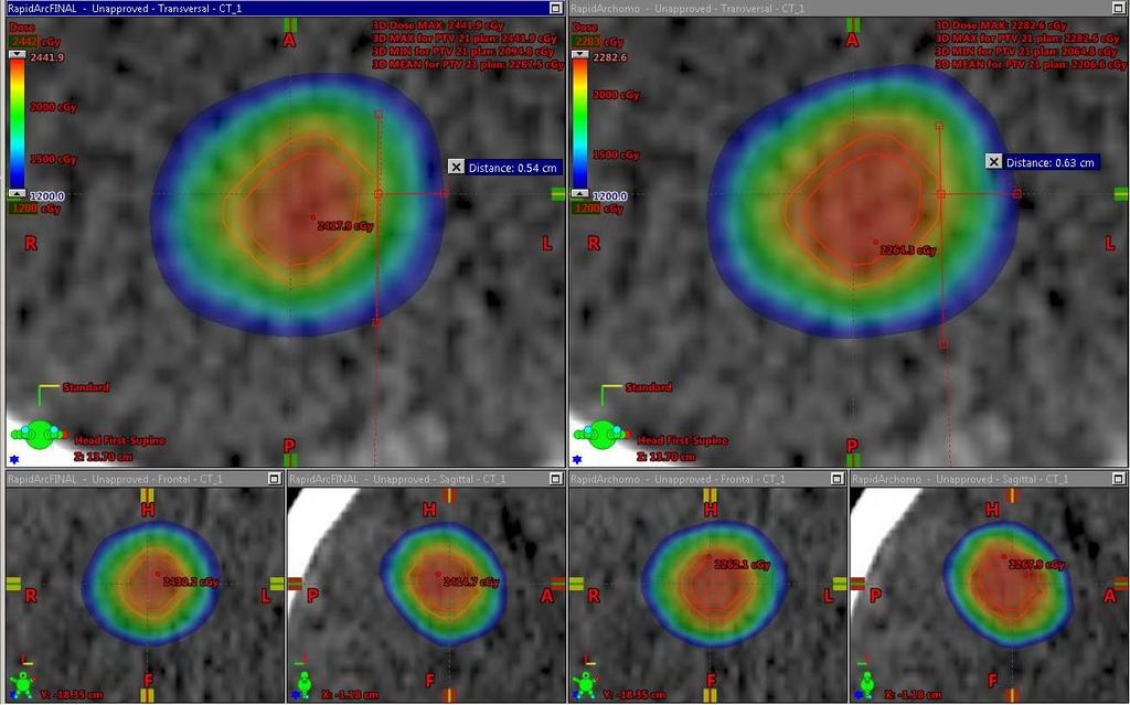 CARACTERÍSTICAS DOSIMÉTRICAS DO PLANEJAMENTO - CURVA DE PRESCRIÇÃO / GRADIENTE DE DOSE (NORMAL TISSUE TOLERANCE) A dose prescrita depende de alguns fatores, tais como: tipo de