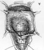 Fig 07. Representação esquemática da plicatura fascial na correção da cistocele e da incontinência por via vaginal. (Kelly-Kennedy) Via suprapúbica - Representada por duas técnicas.