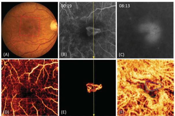 Doenças Maculares OCTA e a Degeneração Macular da Idade A Degeneração Macular da Idade (DMI) é a principal causa de perda de visão na população acima dos 65 anos nos países desenvolvidos, sendo a DMI