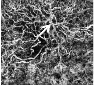 Figura 6 Após terapêutica anti-angiogénica. A seta indica um feeder vessel no centro do complexo neovascular, associado à DMI. Adaptado de Kuehlewein, L. et al.