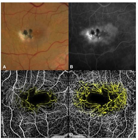 A Telangiectasia Macular tipo 2 (MacTel2), também ela uma entidade patológica rara que afeta predominantemente a área macular, está associada a inúmeros achados: diminuição da transparência