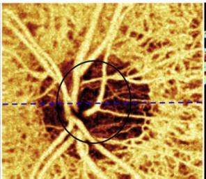 OCTA e o Glaucoma O Glaucoma é a principal causa de cegueira irreversível no mundo com compromisso da CNO, afetando mais 120 milhões de pessoas.