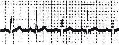 31 telefônica até seu laboratório. Esse foi o primeiro tele-eletrocardiograma da história, o qual ocorreu em 1905 (GIFFONI e TORRES, 2010 ).