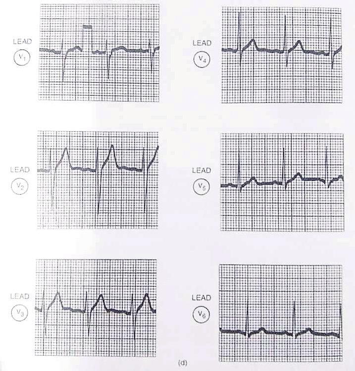 37 Figura 17 - Derivação Unipolar Precordial Fonte: KHANDPUR (2003) Os batimentos do coração são então enviados ao circuito responsável pela impressão do sinal captado em um papel.