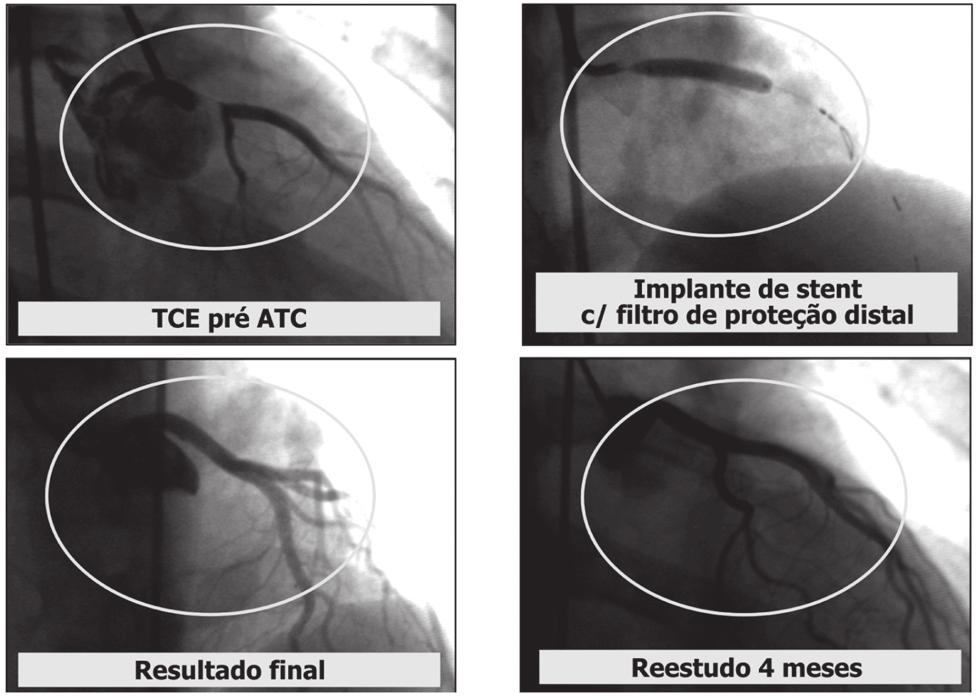 Figura 6 - Exemplo de um dos casos tratados por ATC primária, sendo utilizado: tirofiban, filtro de proteção e stent. Pac. MB, 31 a.
