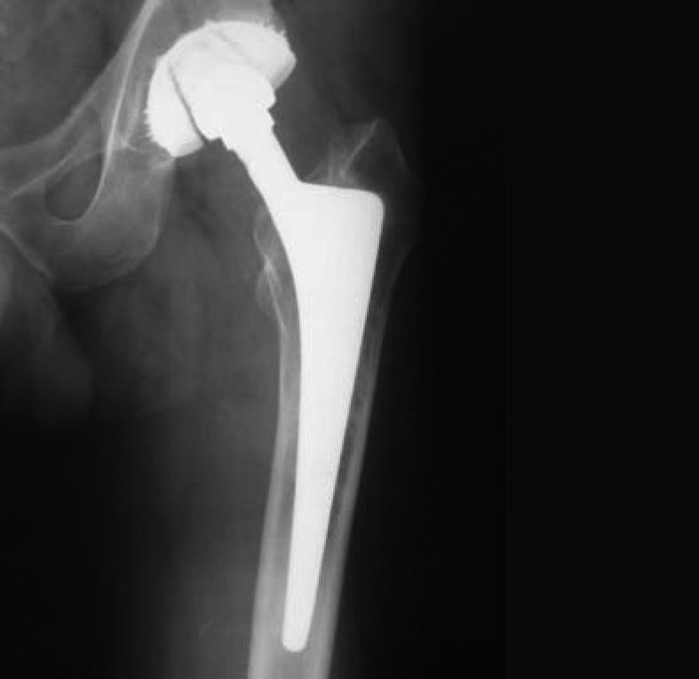 acetabular, mas sem repercussão clínica.