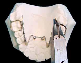 Instalar a aparatologia fixa na próxima seção para que a distalização ocorra no leito medular. Notar a presença do segundo molar (Figura 17).